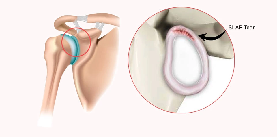 Slap Band Injuries Shoulder Labrum Injury Specialist in Nagarbhavi | SLAP Treatment